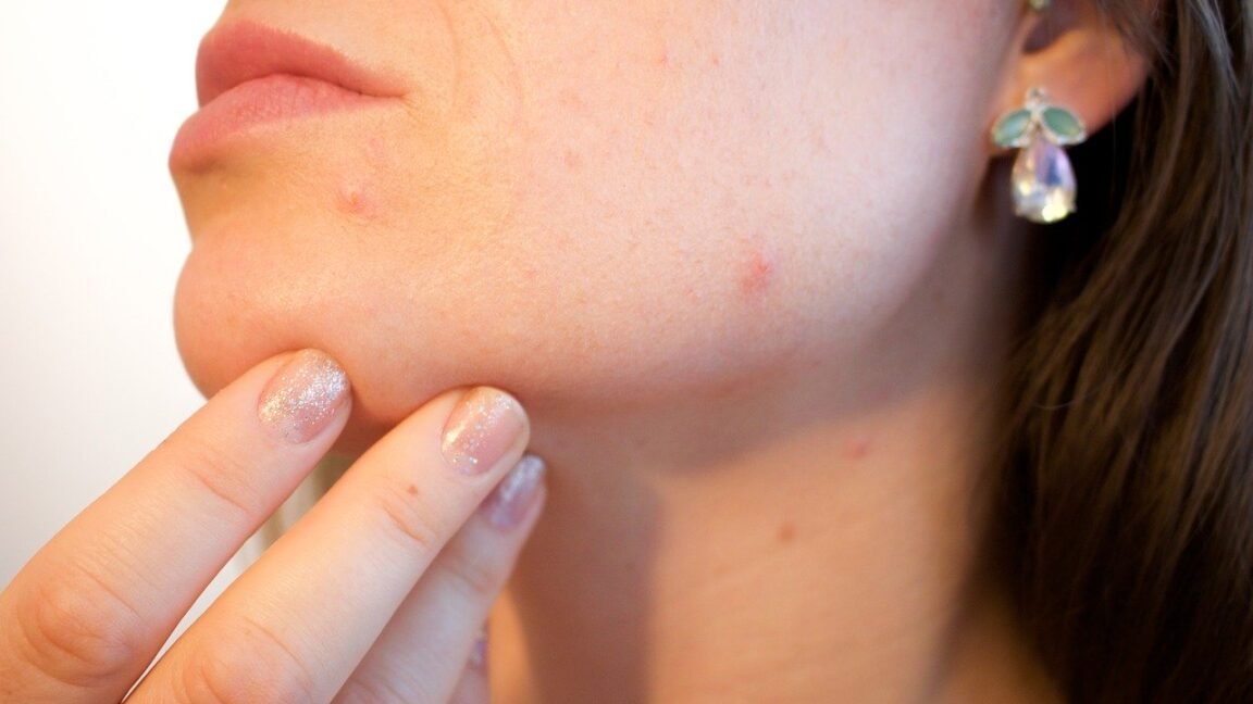 acne pore